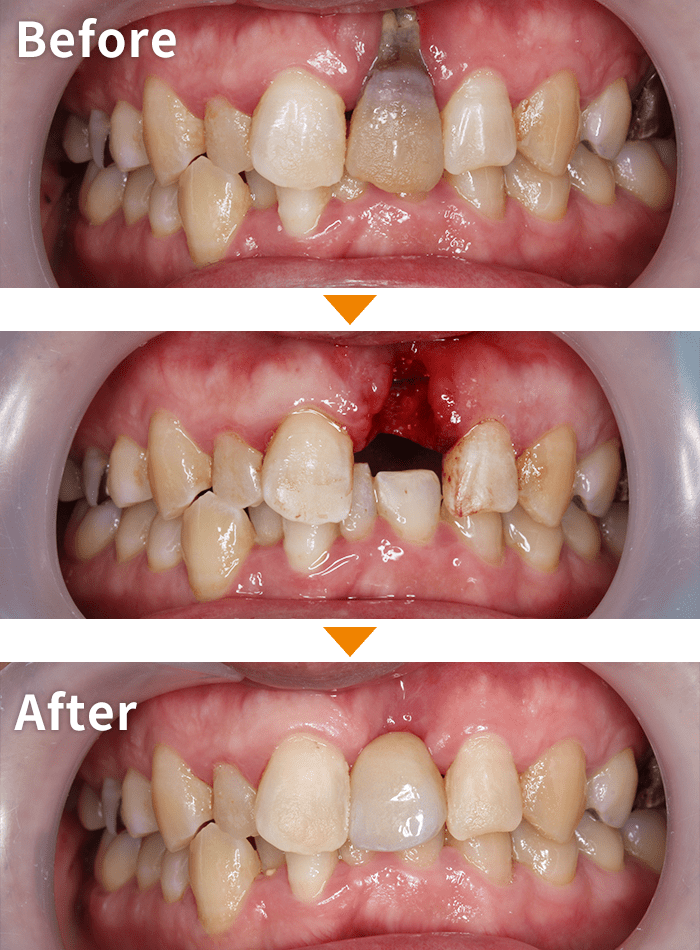 インプラント症例１