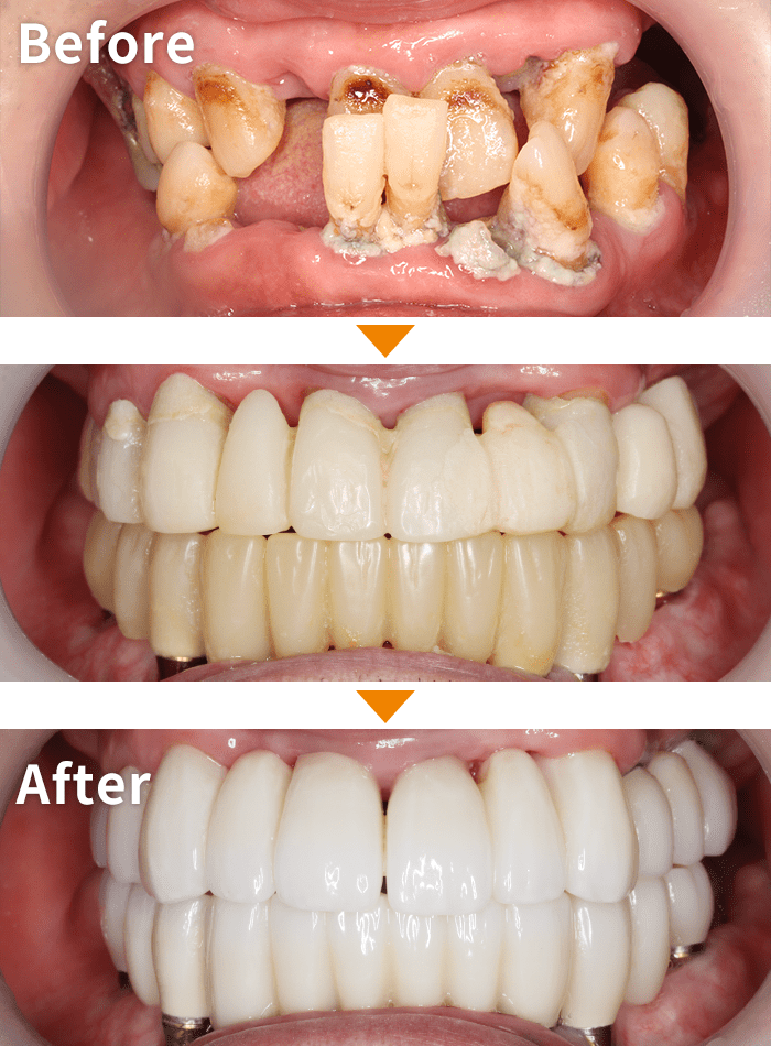 インプラント症例２