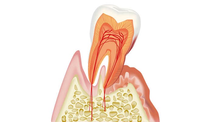 歯周病治療